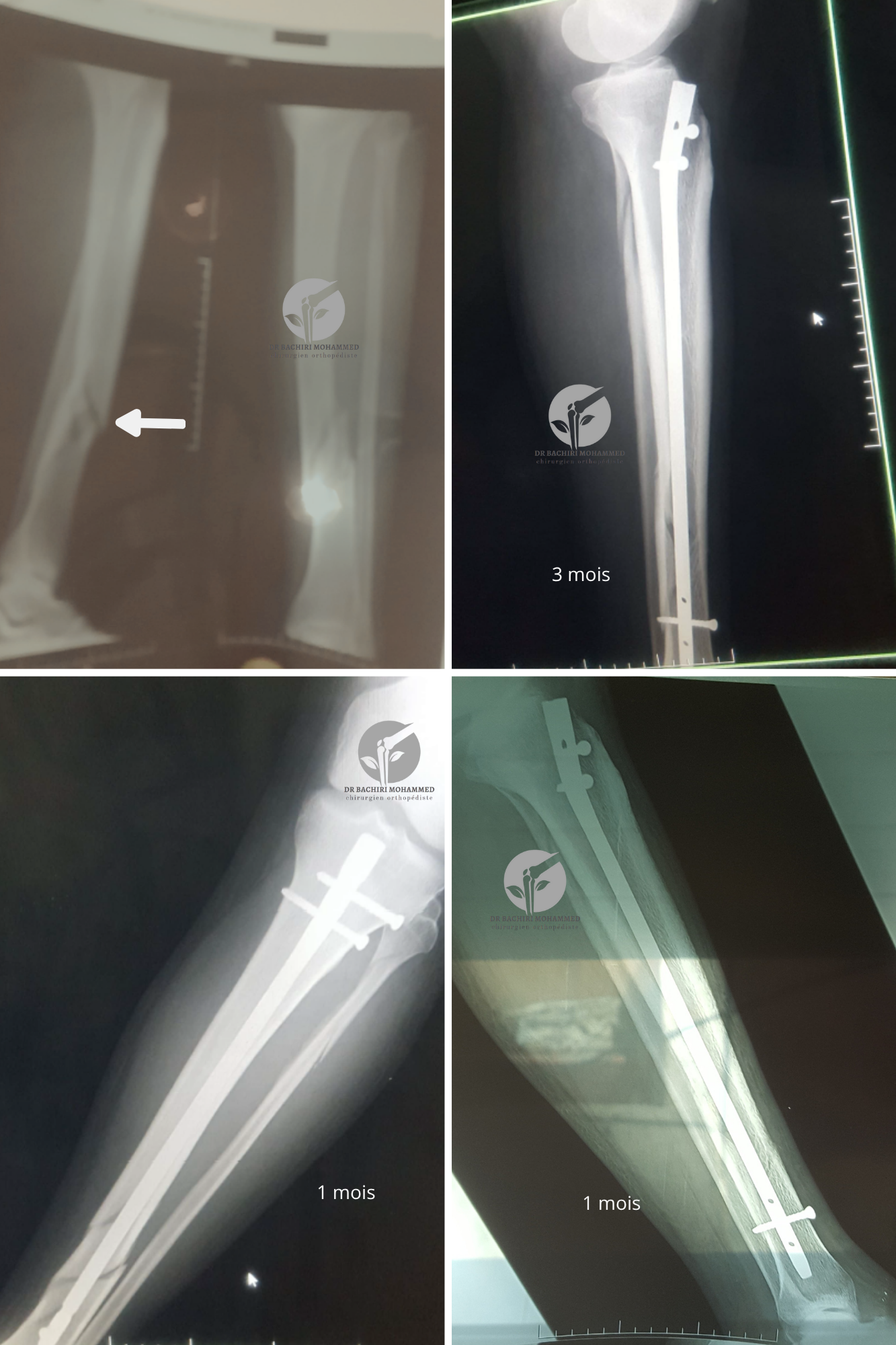Fracture de la jambe avec enclouage par Dr. Bachiri Mohammed à Oujda